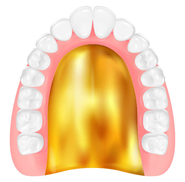 ゴールド床入れ歯のイラスト